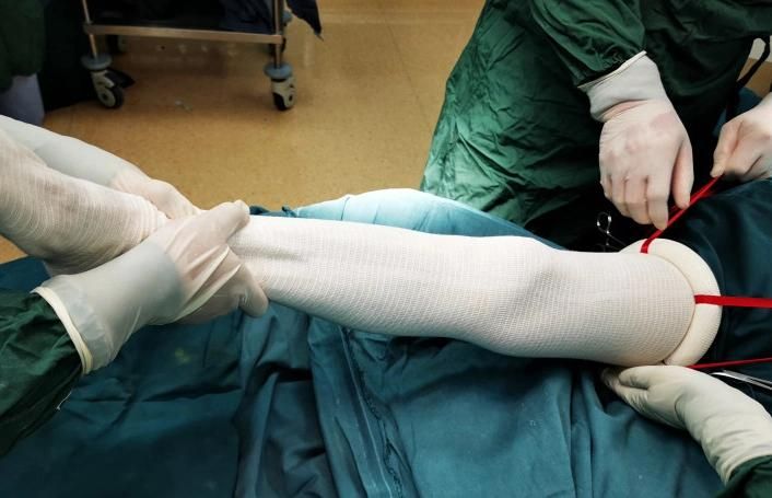 Sterilized Disposable Elastic Tourniquet Exsanguination Silicone Ring for Limb Procedures Blood Occlusion/Removal Safe Efficient Orthopedic Surgical Appliance