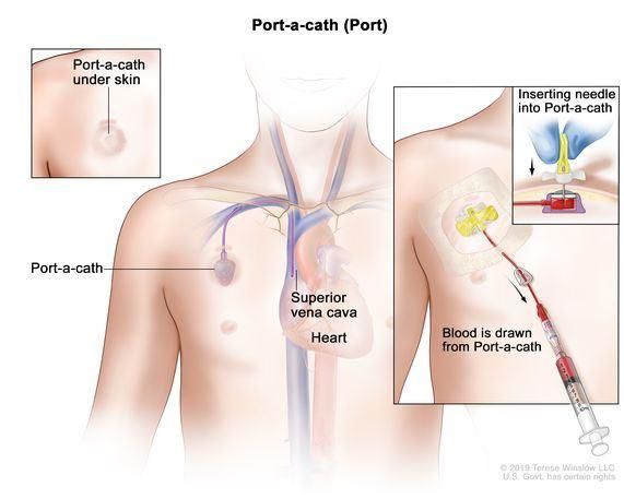 Implantable Port Chemo Port Port-a-Cath (Port)
