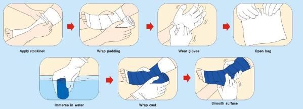 High Strength Waterproof Hand Splint and Brace Orthopedic Fiber Glass Strech
