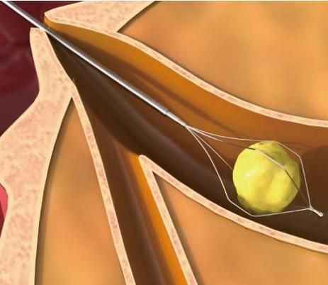 Endoscopic Devices Rotatable Biliary Disposable Stone Extraction Basket for Ercp