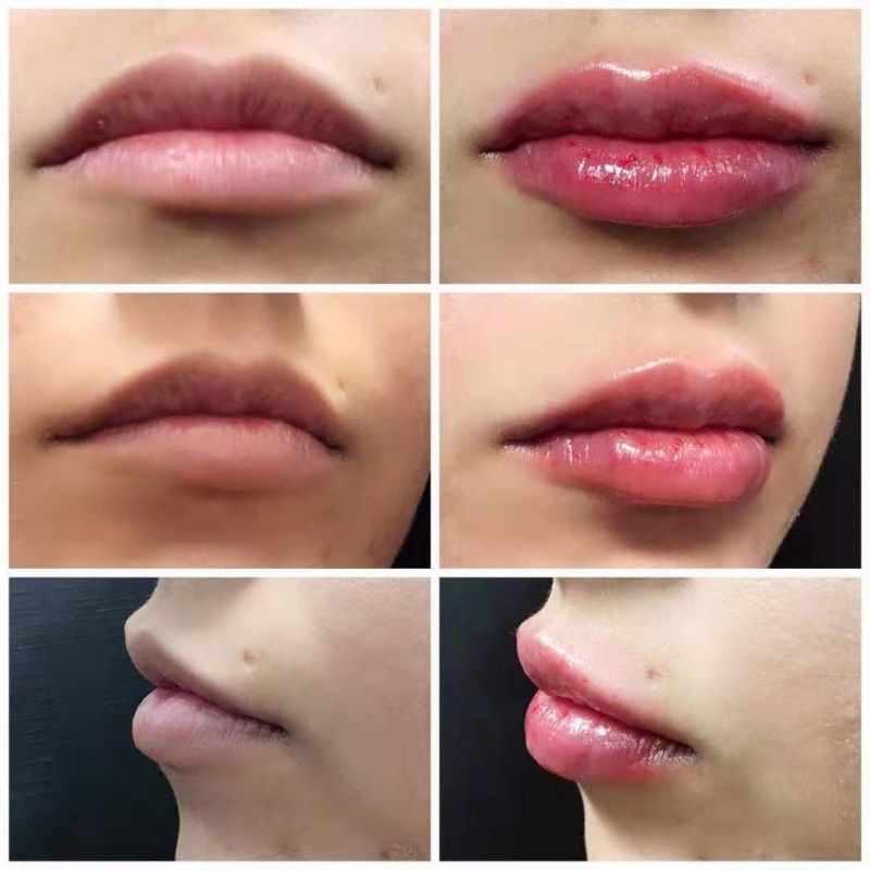 Hyaluronic Acid Gel 1ml Lip Dermal Filler Injections Injectable Dermal Filler