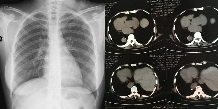 8X10 and 13X17 Inch Medical Dry Inkjet Films for Radiology Department