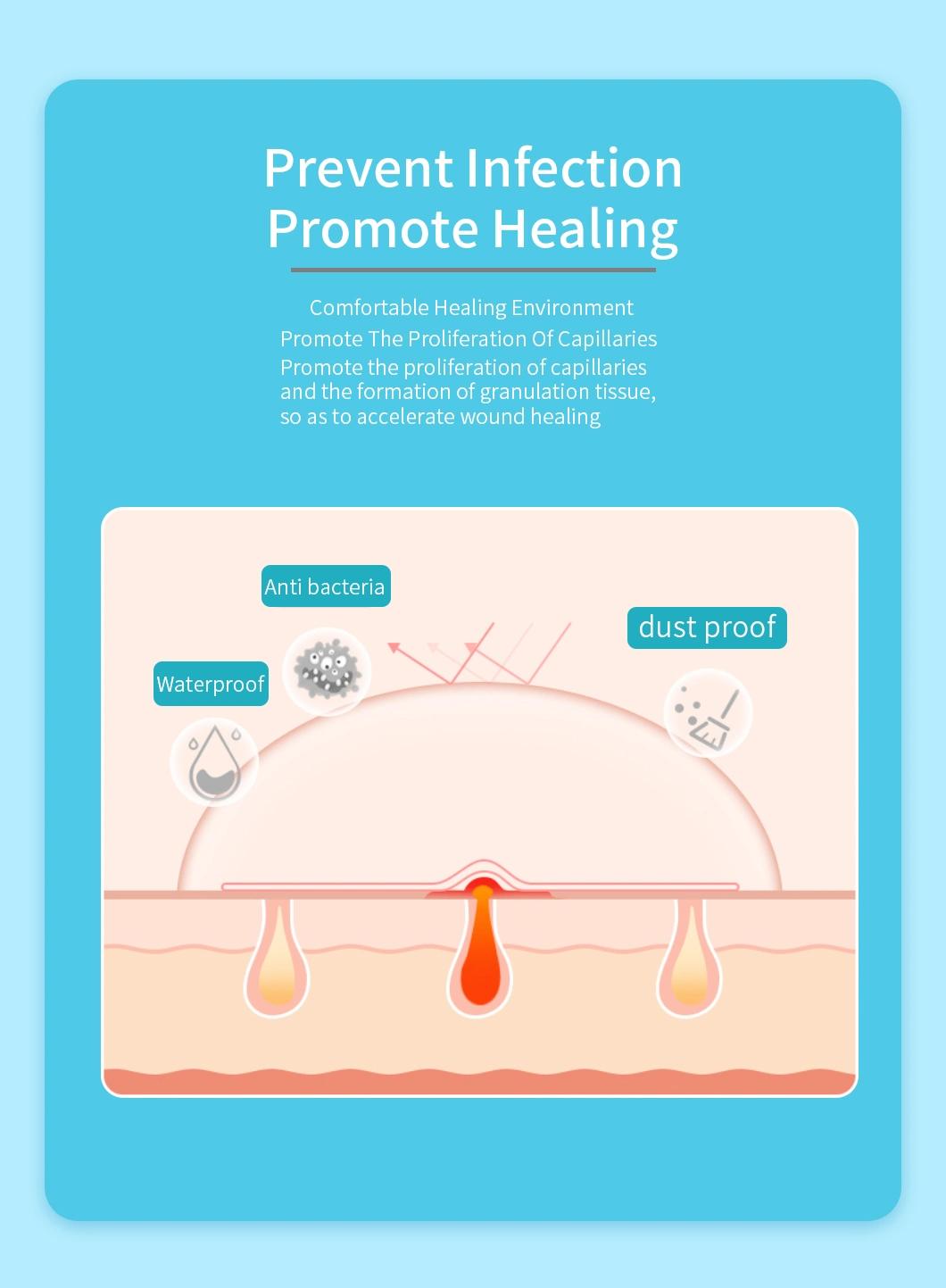 Hydrocolloid Dressing for Superficial Burn Wound