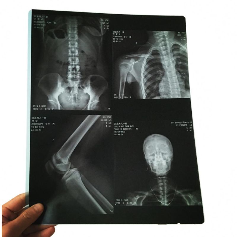 MRI Using Inkjet Dry Medical X-ray Film for Hospital Machine