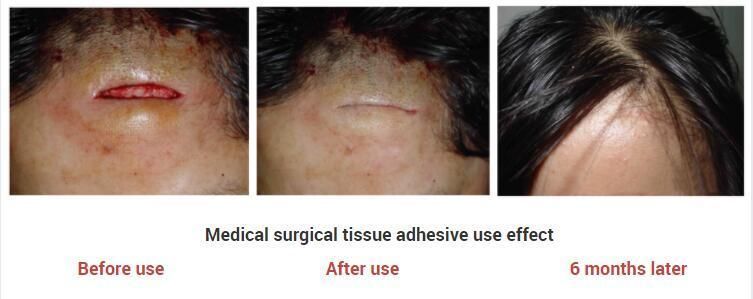 Perfectseal Medical Skin Glue Tissue Adhesive Surgical Glue