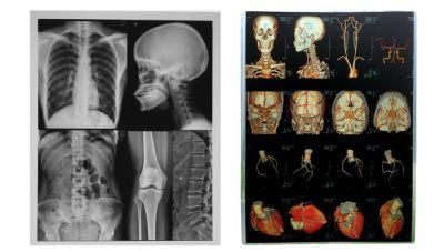 A3 Pet Inkjet Digital X Ray Film Prices for CT/Dr/Ctr/MRI