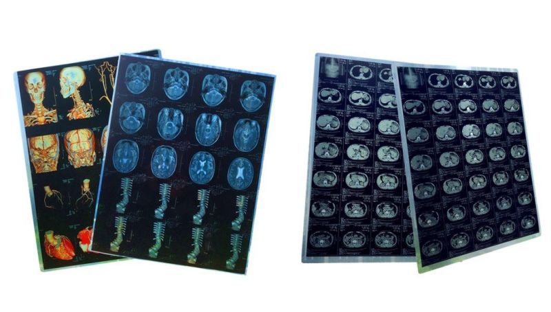 New Laser X-ray Blue Films for Agfa Drystar 5300