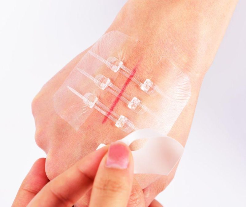 New Design! Medical Skin Adhesive Wound Closure Device Plaster