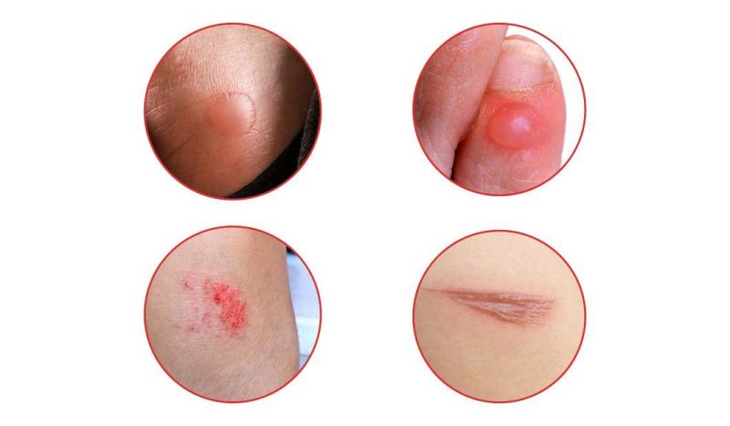 Disposable Waterproof Hydrocolloid Heel Dressing Wound