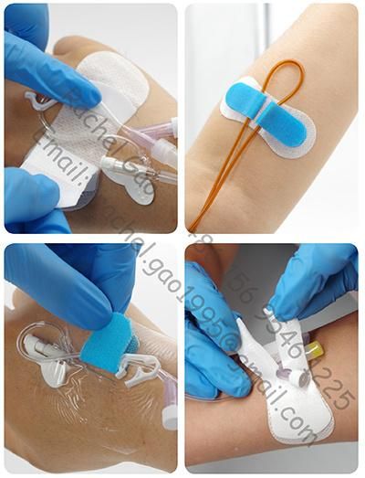 Medical Indwelling Needle IV Set for Securement Fixation