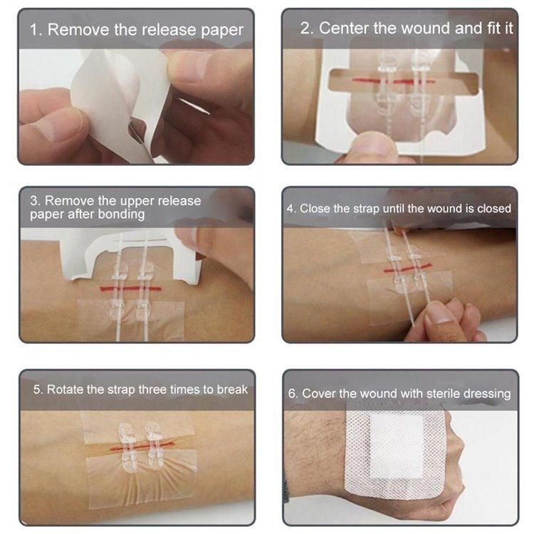 Bluenjoy Medical Grade PU Wound Closure Zipper Skin Wound Closure Device