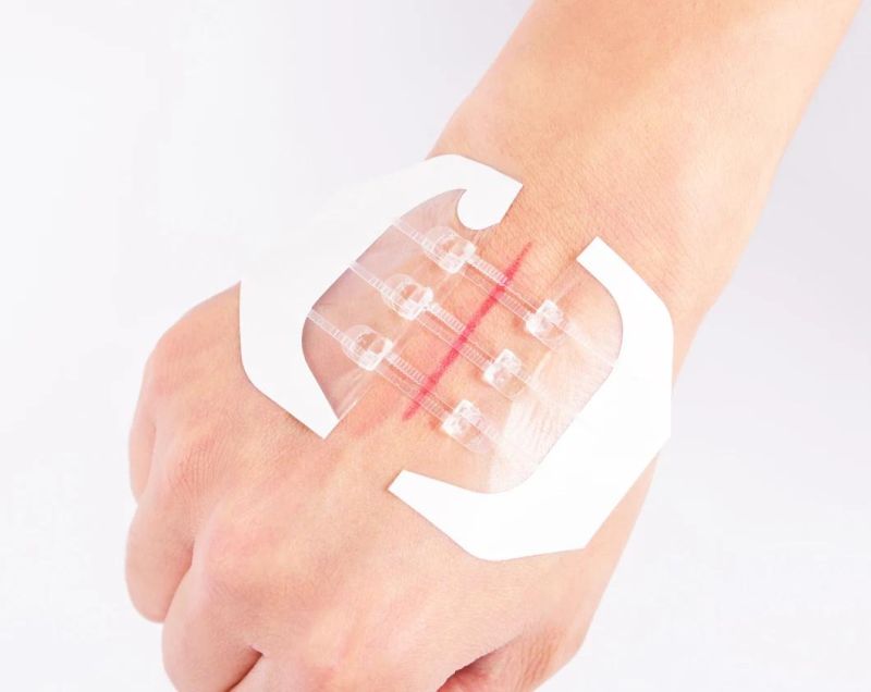 CE Approved Medical Adhesive Wound Closure Device