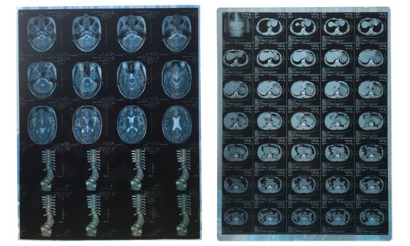 Medical X-ray Laser Film for Epson and FUJI Printer
