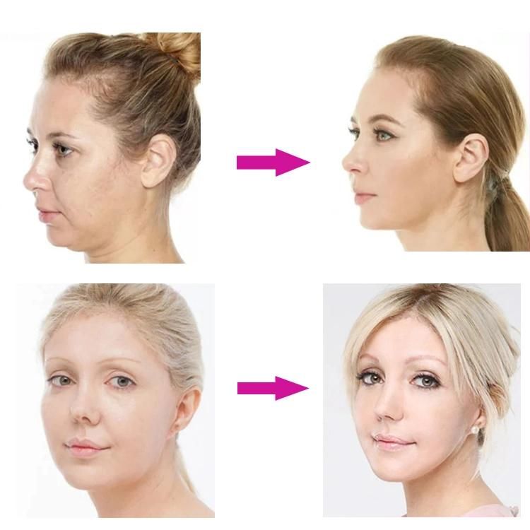 Heremefill Lifts and Tightens The Skin to Increase Skin Elasticity