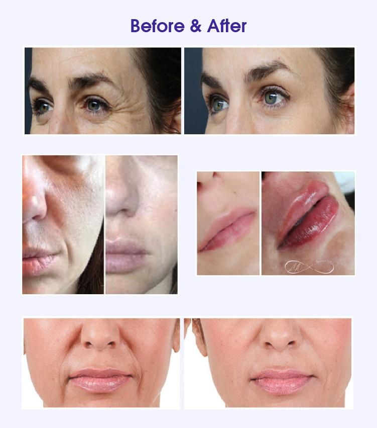 Hyaluronic Acid Dermal Filler Face Wrinkles