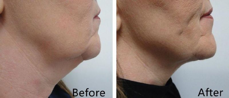 Fat Dissolving Solution Injection Double Chin Burning Fat Serum