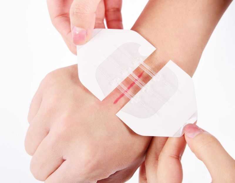 New Design! Medical Skin Adhesive Wound Closure Device Plaster