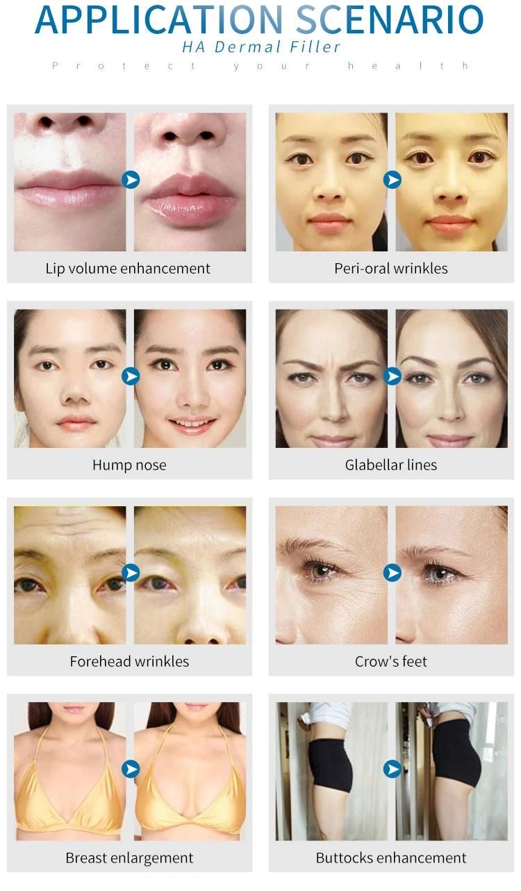 Ha for Forehead Mouth Lines Lips Plumper Hyaluronic Acid Cross Linked Dermal Filler