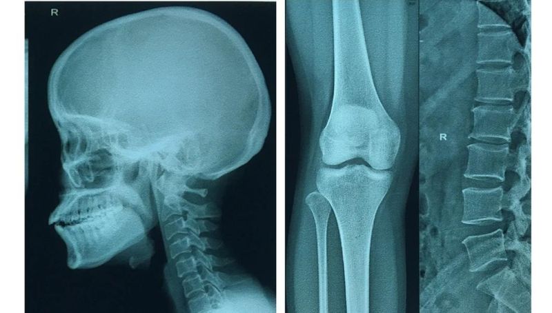 Laser Film for Medical X-ray Image Output Printing