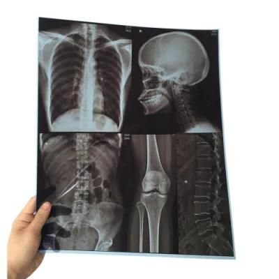 10X12 Inch Blue Inkjet CT Cr MRI Medical Dry X Ray Film