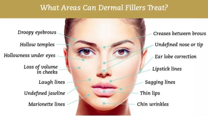 Loyoderm Lip Inejctions Dermal Fillers That Have Hyaluronic Acid