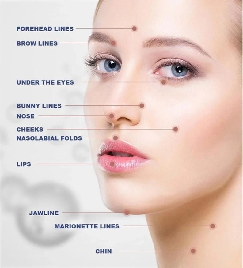 Lip Filler 1ml Derm Hyaluronic Acid Dermal Fillers