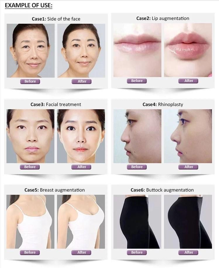 Kroea Anti-Aging / Lip Elravie 1ml Acido Hialuronicico Inyectable / Hyaluronic Acid Filler Injection for Lip Augumentation