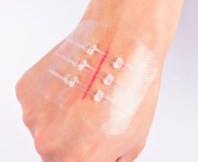 New Design! Medical Skin Adhesive Wound Closure Device Plaster