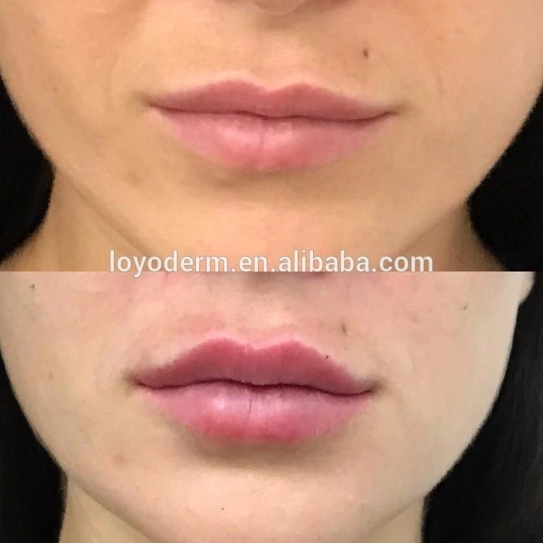 CE Cross-Linked Injectable Dermal Lip Filler 2ml Sodium Hyaluronate Gel Hyaluronic Acid Injection