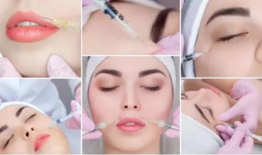 Dermal Filler Hyaluronic Acid Gel for Nose Augmentation