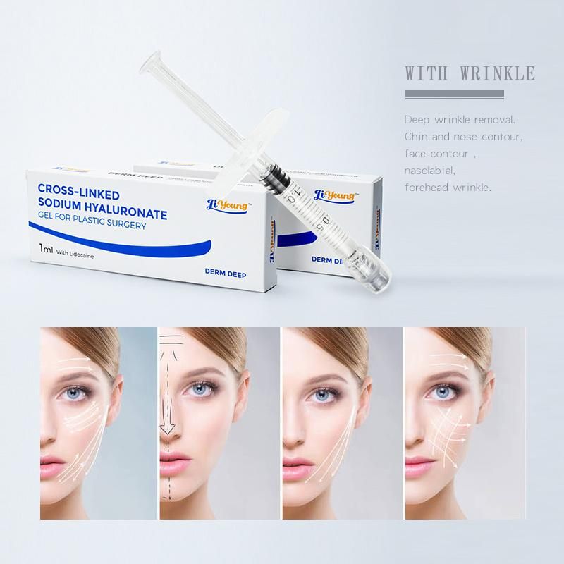 Best Price Crosslinked Hyaluronic Acid Dermal Filler/Ha Filler for Lips