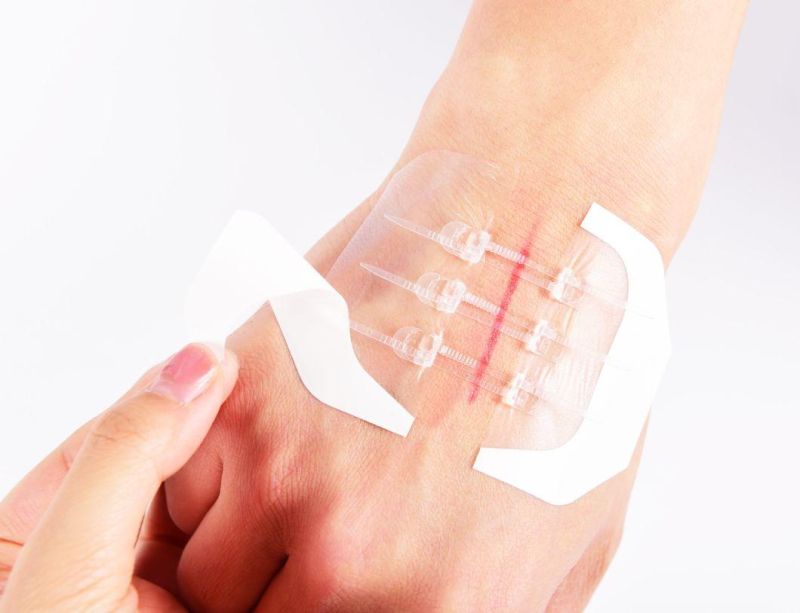 Medical Skin Adhesive Wound Closure Device