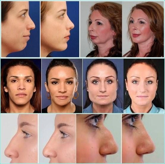 Ultra 3 and Ultra 4 Juvaderm Dermal Filler