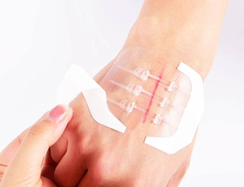 CE Approved Medical Adhesive Wound Closure Device