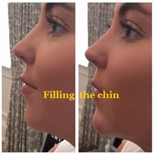 Ha Sodium Hyaluronate Injections with CE Certification