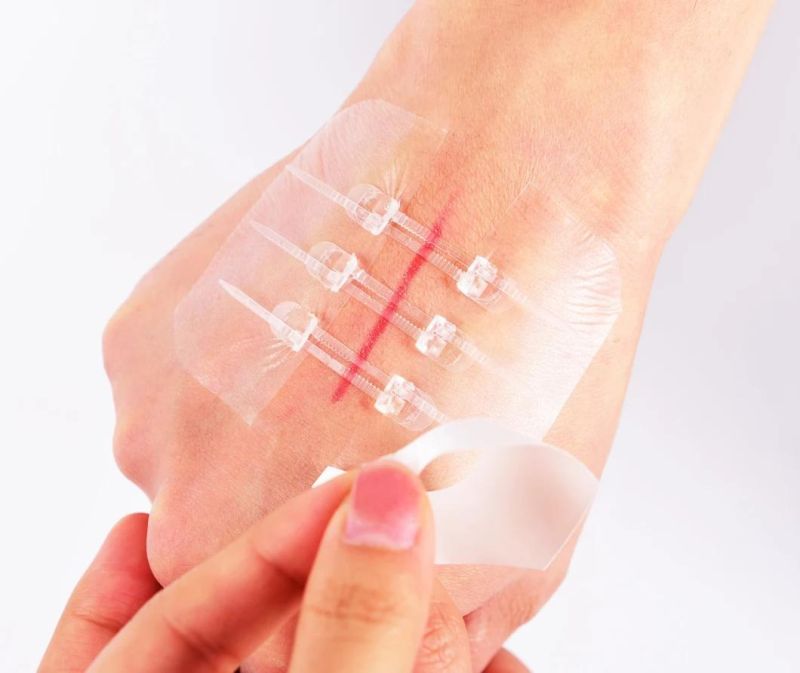 CE Approved Medical Adhesive Wound Closure Device