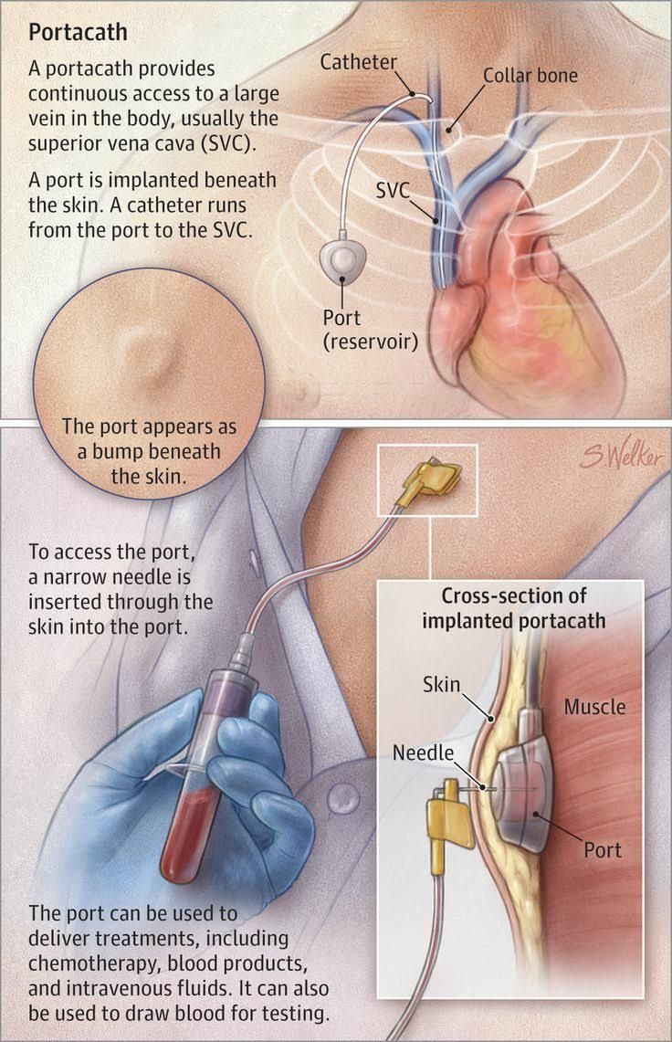 Implantable Port Chemo Port Port-a-Cath (Port)