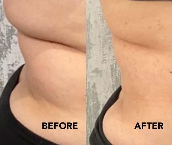 Fat Dissolving Solution Injection Double Chin Burning Fat Serum