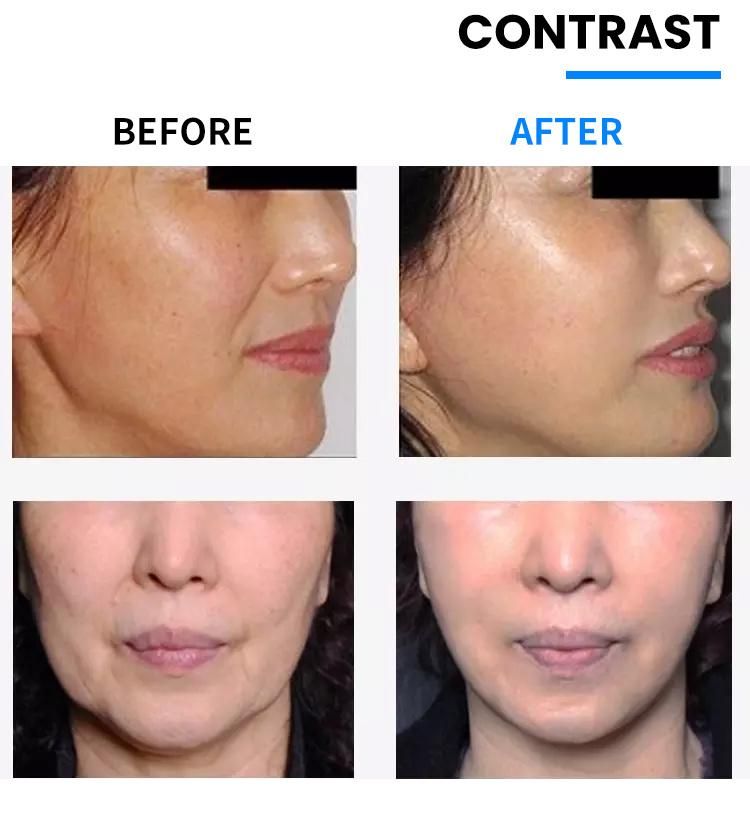 Korea Lift 3D Pdo Threads for Face Lifting