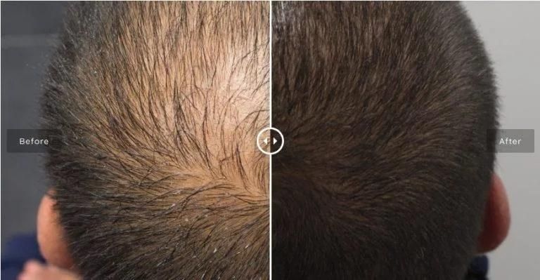 Best Fastest Natural Remedies Bald Curly Forehead Hair Loss Growth Hairgain Treatment for Men