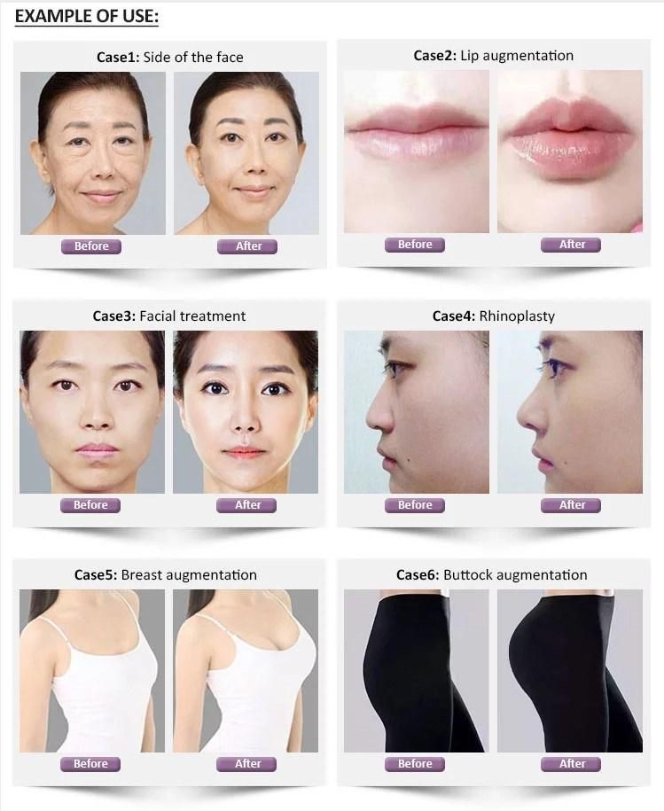 Hyaluronic Acid Dermal Filler Injectable Elravie Certified Non-Animal Fermentation Cross-Linked Cohesive