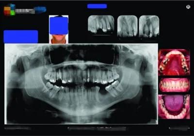 Kid Dental X Ray Blue Film