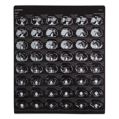 Inkjet Pet Medical Film for X-ray Image Output Blue Film