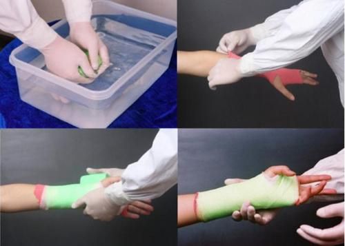 Water Activated Medical Orthopedic Fiberglass Casting Tape Free Samples Orthopedic Cast Colors