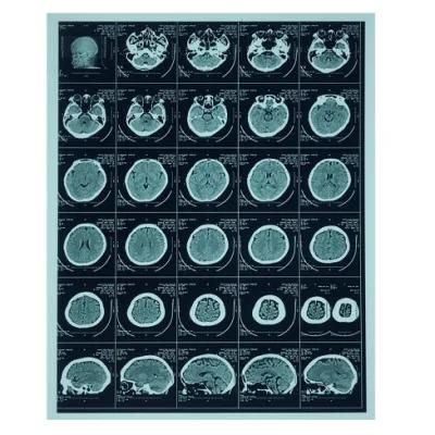 Medical X-ray Film/14X17 Inch Thermal Dry Films