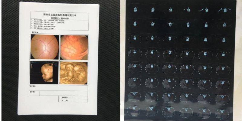 Inkjet Dry Blue Medical X Ray Film