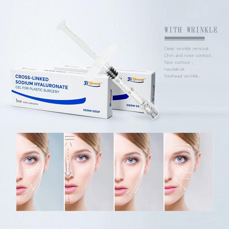 Anti Wrinkle Hyaluronic Acid Dermal Filler Facial Plastic Revolax Filler