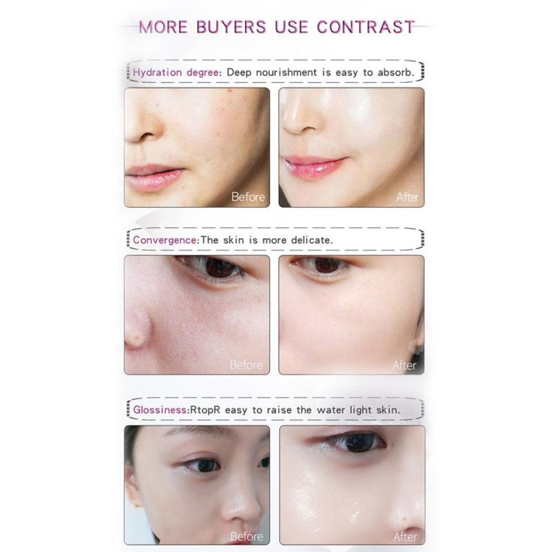 2020 The Hottest Sale Hyaluronic Acid Injection Neuramis Dermal Filler