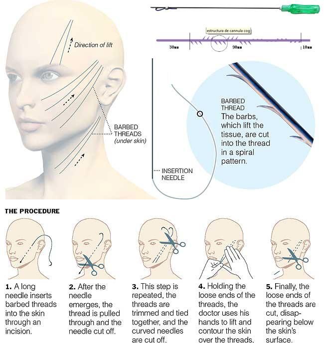 MID Face Sugar Skin Strings Threading Injection Full Facelift Cost Price