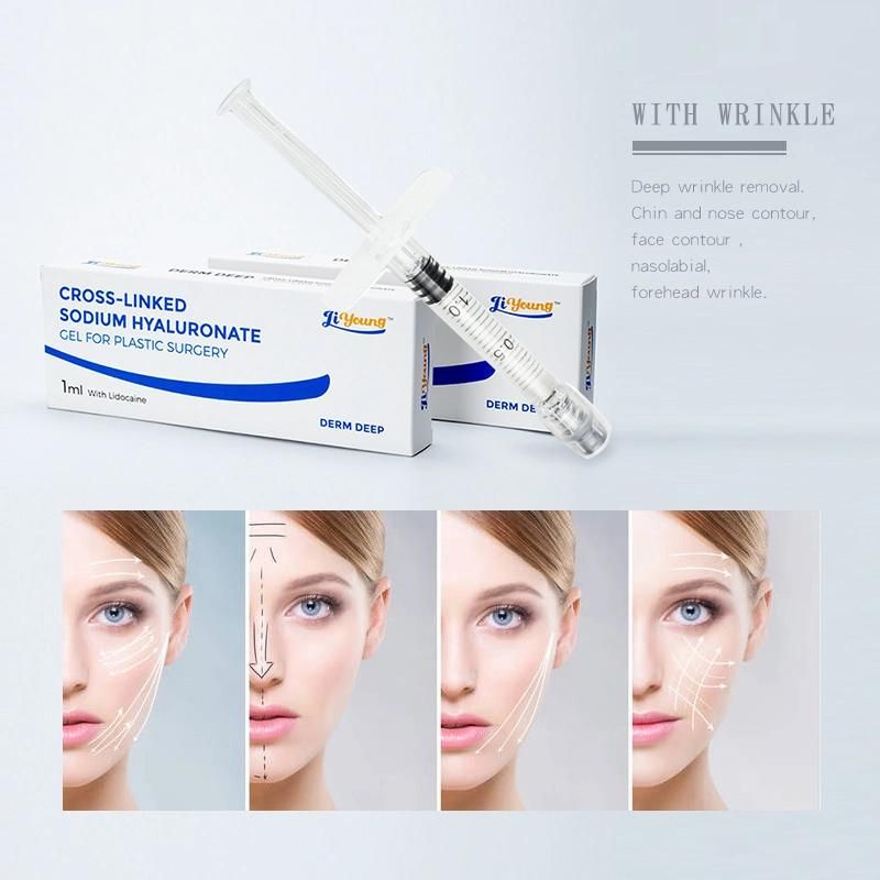 10ml Medical Grade Cross-Linked Bd Needle Hyaluronic Acid Dermal Filler